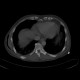 RTA, pneumothorax, subcutaneous emphysema, soft tissue damage, fracture of iliac crest, rib fracture: CT - Computed tomography