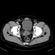 Rudimentary uterus: CT - Computed tomography