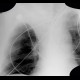 Atelectasis of right upper lobe of lung: X-ray - Plain radiograph