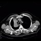 Atelectasis of right upper lobe of lung: CT - Computed tomography