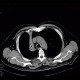 Atelectasis of right upper lobe of lung: CT - Computed tomography