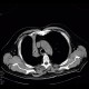 Atelectasis of right upper lobe of lung: CT - Computed tomography