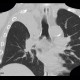 Atelectasis of right upper lobe of lung: CT - Computed tomography