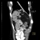 Rupture of the diaphragm, diaphragmatic hernia: CT - Computed tomography