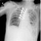 Rupture of the diaphragm, diaphragmatic hernia: X-ray - Plain radiograph