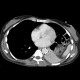 Rupture of the diaphragm, diaphragmatic hernia: CT - Computed tomography