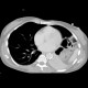 Rupture of the diaphragm, diaphragmatic hernia: CT - Computed tomography