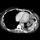 Rupture of the diaphragm, diaphragmatic hernia: CT - Computed tomography