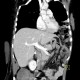 Rupture of the diaphragm, diaphragmatic hernia: CT - Computed tomography