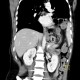 Rupture of the diaphragm, diaphragmatic hernia: CT - Computed tomography