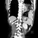 Rupture of the diaphragm, diaphragmatic hernia: CT - Computed tomography