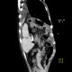 Rupture of the diaphragm, diaphragmatic hernia: CT - Computed tomography