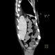 Rupture of the diaphragm, diaphragmatic hernia: CT - Computed tomography