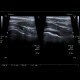 Reactive arthritis, arthritis in salmonellosis, salmonella: US - Ultrasound