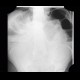 Meteorism, distention of colon, reflex distention, vertebrogenic pain syndrome, compression fracture of vertebra: X-ray - Plain radiograph