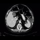 Meteorism, distention of colon, reflex distention, vertebrogenic pain syndrome, compression fracture of vertebra: CT - Computed tomography