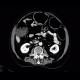 Meteorism, distention of colon, reflex distention, vertebrogenic pain syndrome, compression fracture of vertebra: CT - Computed tomography