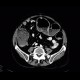 Meteorism, distention of colon, reflex distention, vertebrogenic pain syndrome, compression fracture of vertebra: CT - Computed tomography
