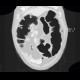 Meteorism, distention of colon, reflex distention, vertebrogenic pain syndrome, compression fracture of vertebra: CT - Computed tomography