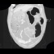 Meteorism, distention of colon, reflex distention, vertebrogenic pain syndrome, compression fracture of vertebra: CT - Computed tomography
