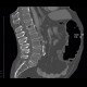 Meteorism, distention of colon, reflex distention, vertebrogenic pain syndrome, compression fracture of vertebra: CT - Computed tomography