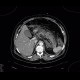 Splenectomy, regenerative splenunculus: CT - Computed tomography