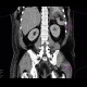 Splenectomy, regenerative splenunculus: CT - Computed tomography