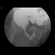 Rectovaginal fistula, diverticular disease of the sigmoid colon: RF - Fluoroscopy