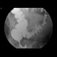 Rectovaginal fistula, diverticular disease of the sigmoid colon: RF - Fluoroscopy