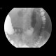 Rectovaginal fistula, diverticular disease of the sigmoid colon: RF - Fluoroscopy