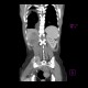 Renal cell carcinoma, metastasis into pelvis: CT - Computed tomography