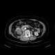 Renal cell carcinoma, RFA, embolization, follow-up: CT - Computed tomography