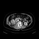 Renal cell carcinoma, RFA, embolization, follow-up: CT - Computed tomography