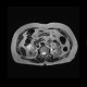 Renal cell carcinoma, RFA, embolization, follow-up: MRI - Magnetic Resonance Imaging