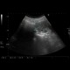 Renal cell carcinoma, RFA, embolization, follow-up: US - Ultrasound