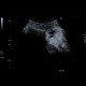 Renal cell carcinoma, RFA, embolization, follow-up, CEUS: US - Ultrasound