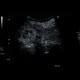 Renal cell carcinoma, RFA, embolization, follow-up, CEUS: US - Ultrasound