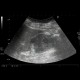 Renal cell carcinoma, RFA, embolization, follow-up: US - Ultrasound