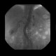 Renal cell carcinoma, RFA, embolization, follow-up: AG - Angiography