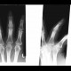 Replacement of interphalangeal joint: X-ray - Plain radiograph