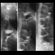 Resection of oesophagus, colon interponat: RF - Fluoroscopy