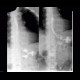 Resection of stomach, end-to-side anastomosis: RF - Fluoroscopy