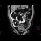 Testicular retention in the inquinal canal: CT - Computed tomography