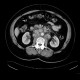 Retroperitoneal lymphadenopathy: CT - Computed tomography