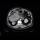 Retroperitoneal hematoma, active bleeding, revision, drain, edema of small bowel: CT - Computed tomography