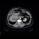 Retroperitoneal hematoma, active bleeding, revision, drain, edema of small bowel: CT - Computed tomography