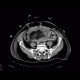 Retroperitoneal hematoma, active bleeding, revision, drain, edema of small bowel: CT - Computed tomography