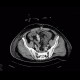 Retroperitoneal hematoma, active bleeding, revision, drain, edema of small bowel, fat stripe: CT - Computed tomography