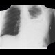 Gauze, radioopaque stripe: X-ray - Plain radiograph
