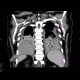 Pneumonia, liquefaction: CT - Computed tomography